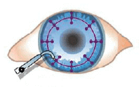 CK procedure diagram