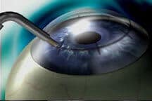 Conductive Keratoplasty image