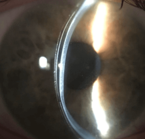 A scleral lens worn over a keratoconus cornea.