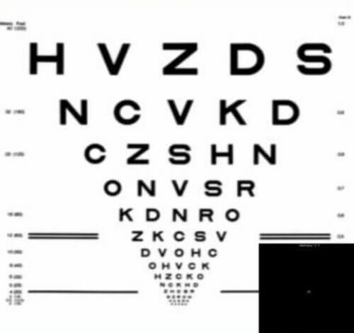 Higher Order Aberration Correcting Optics over a Severe Irregular Cornea Condition