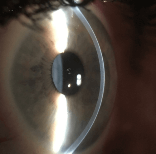 Profile of a normal cornea, note the smooth dome shape.