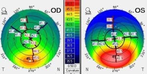 Left eye shows worse keratoconus