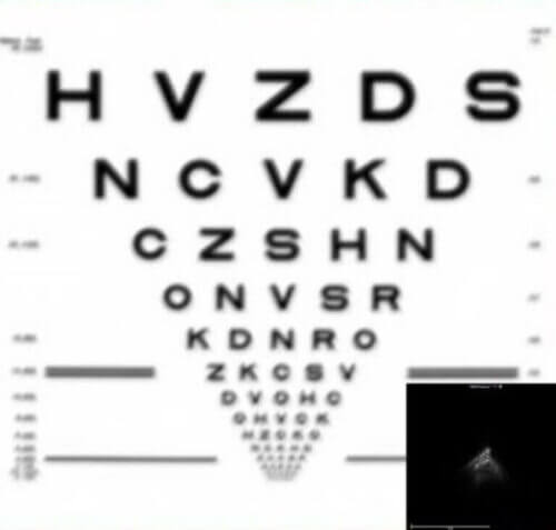 Visual simulation of traditional scleral lens optics over severe keratoconus.