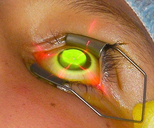Corneal collagen crosslinking eye closeup