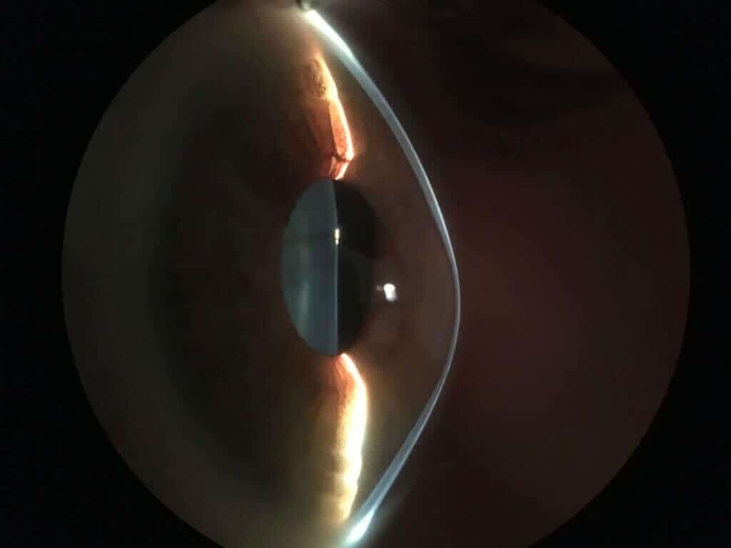 Profile of a keratoconus cornea