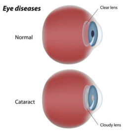 Cataract diagram
