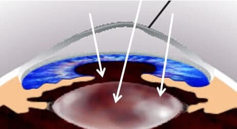 Cornea diagram
