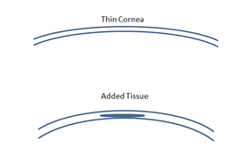 Preserved corneal tissue inlay