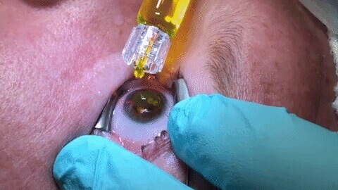 Patient getting eye treatment