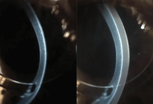 Side by side comparison of a routine soft lens and a custom soft lens.