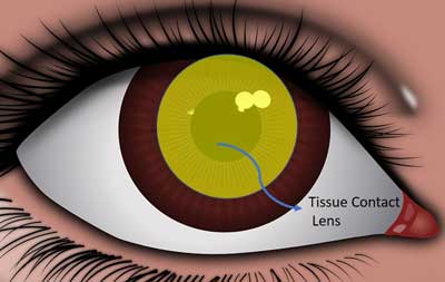 tissue contact lens diagram