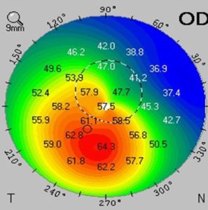 Keratoconic cone