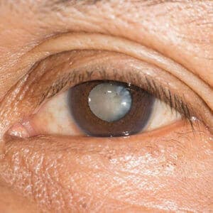 Close up of Cataract