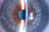 cornea transplant image