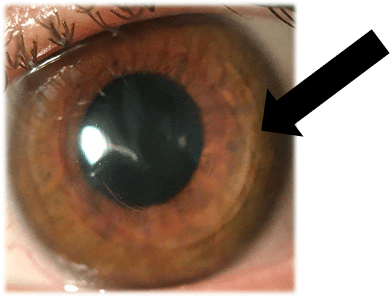 CTAK cornea tissue