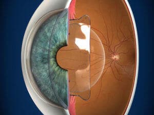 Phakic Intraocular Lens