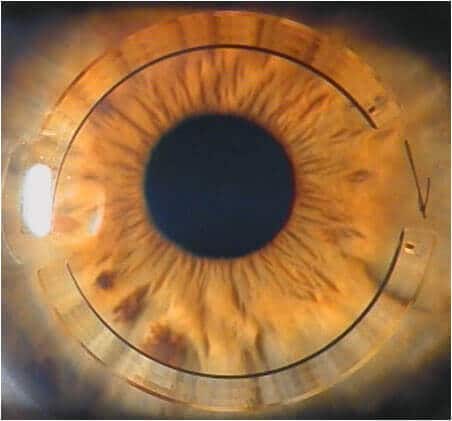 Implantable intracorneal ring segments close up