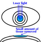 PRK diagram