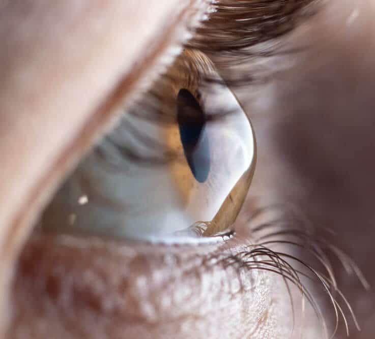 Close up of eye with keratoconus