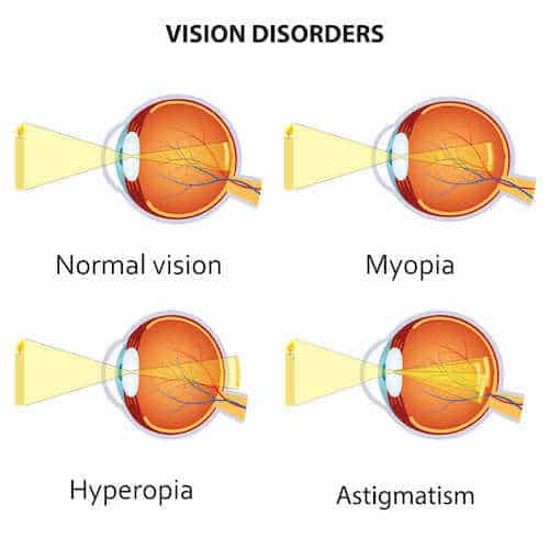 diagram of vision disorders