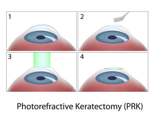 PRK diagram